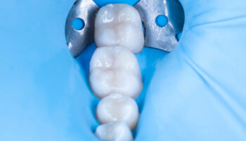 La ce ajută diga în stomatologie?