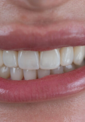 Fațete compozite prin injectare: estetică dentară digitală, minim invazivă